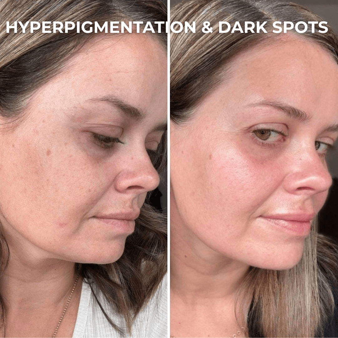 PDRN Collagen Peptides Hydrogel Mask